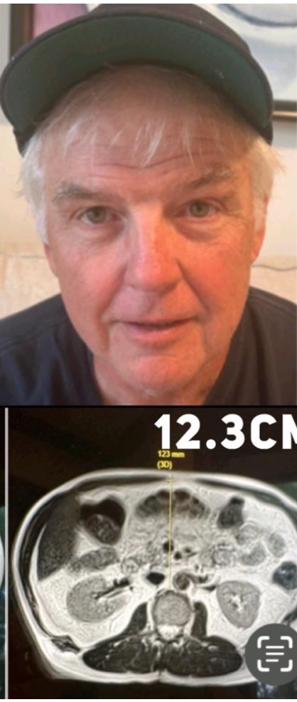 Charlie After photo