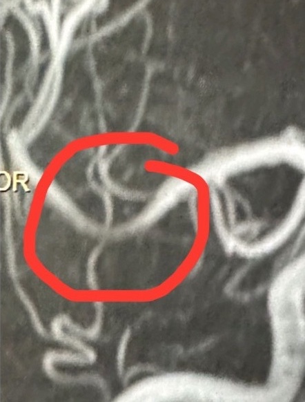 Henry L. Brain After photo