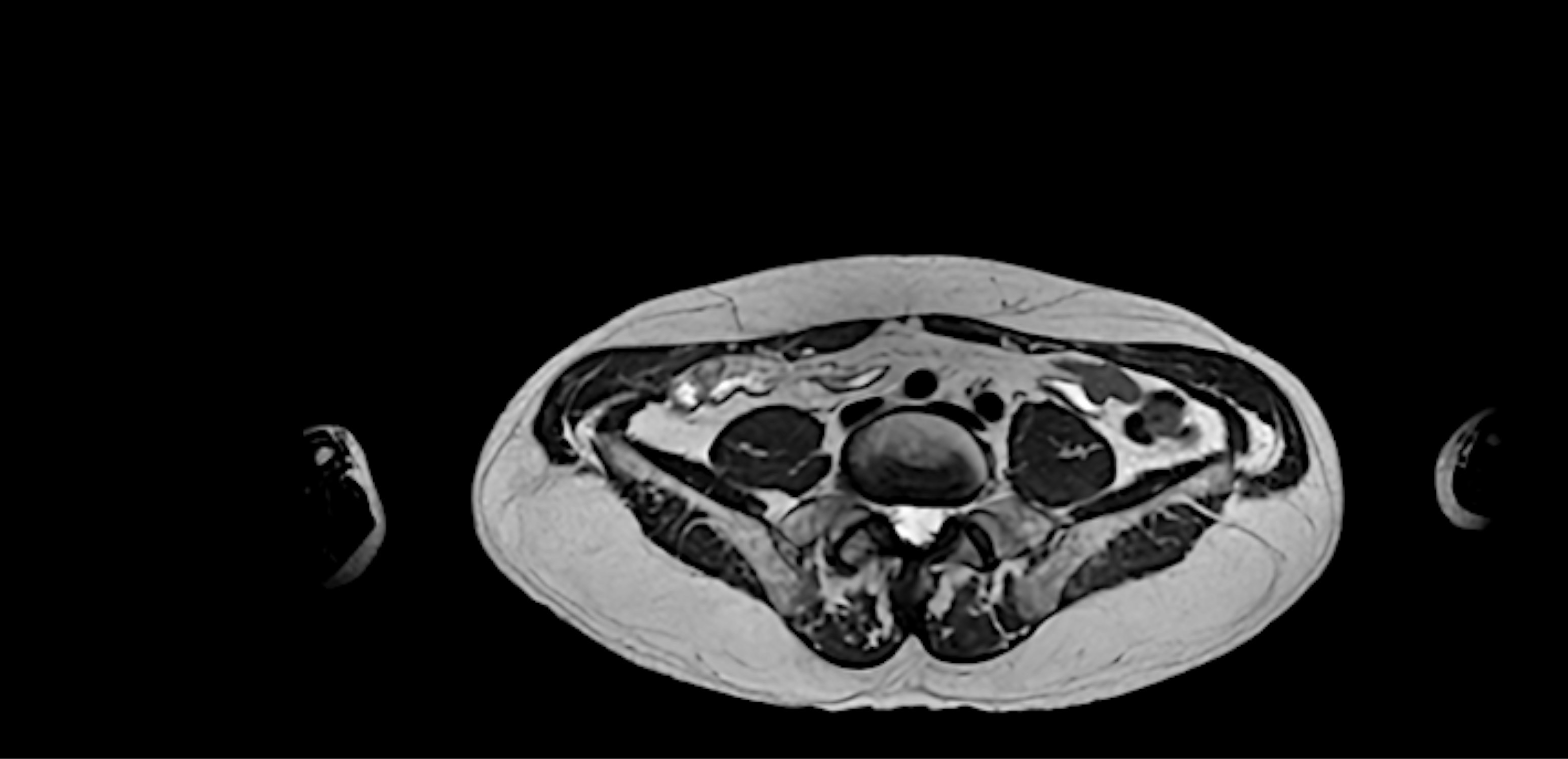 Joe O. Abdomen MRI after photo