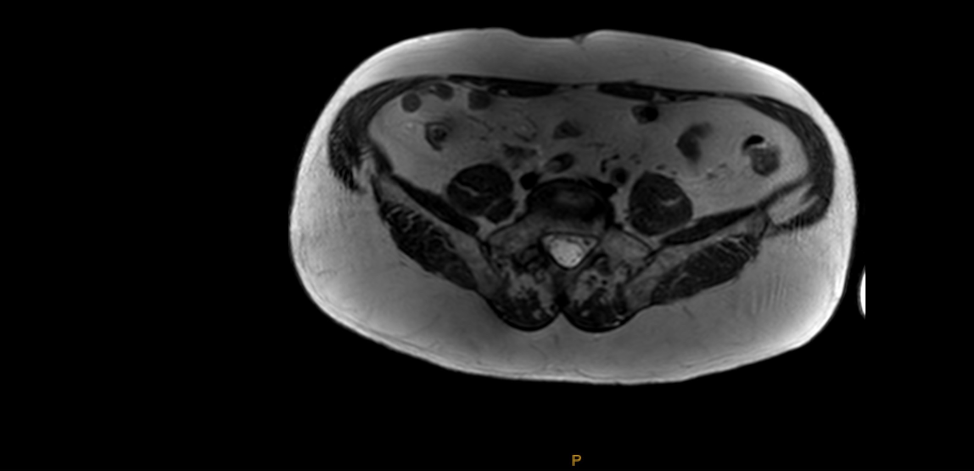 Joe O. Abdomen MRI before photo