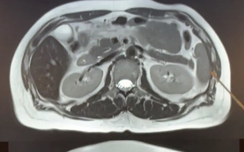 Steve K. Abdomen After photo