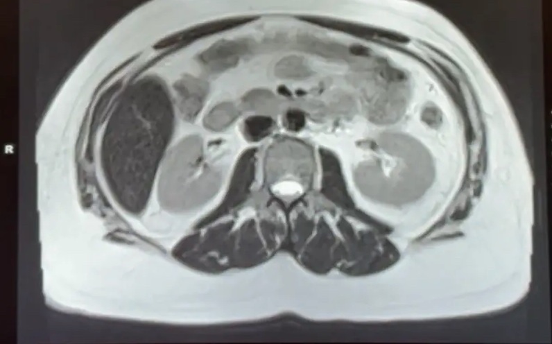 Steve K. Abdomen Before photo